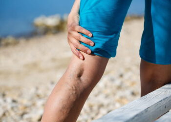 علاج الدوالي وعلاج دوالى الساقين نهائيا